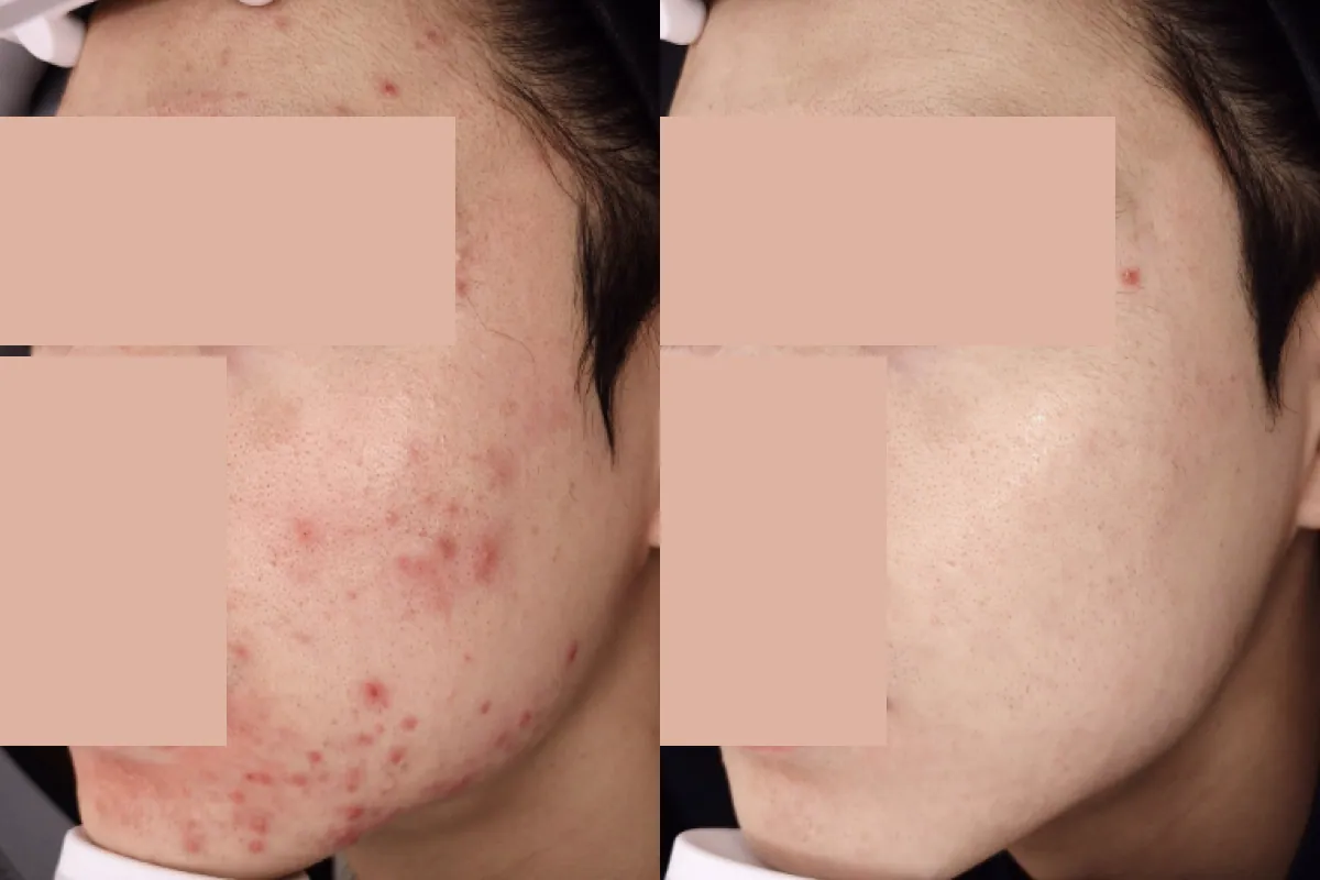 严重脓疱性痤疮治疗前后对比照片