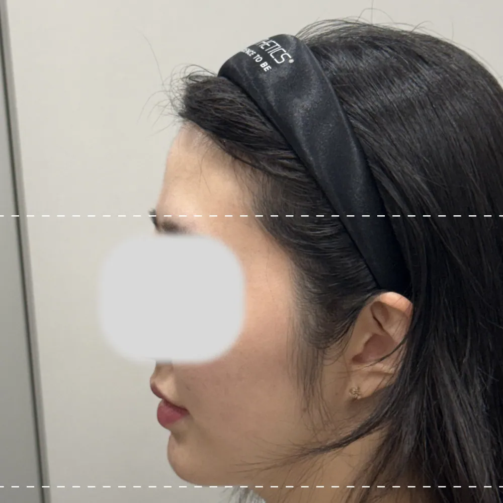 施术前额部玻尿酸呈90度角