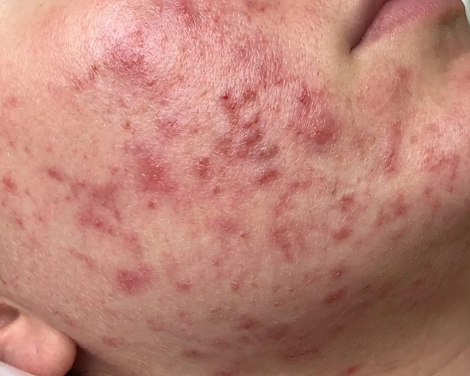 炎症后色素沉着